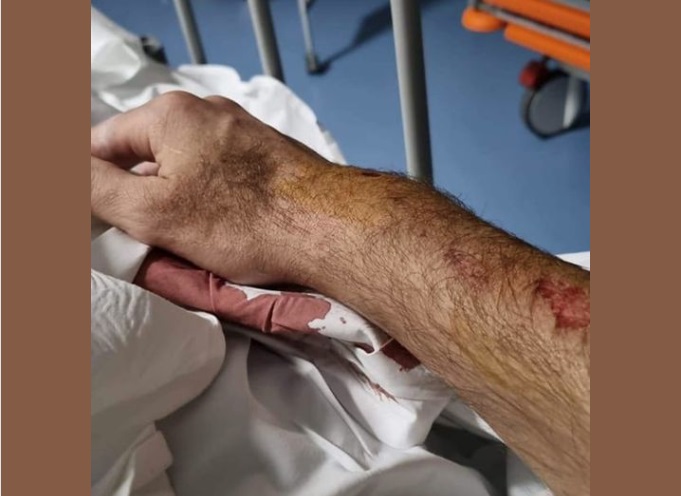 Slomljena ruka gosta koji je branio napadnutu ženu 